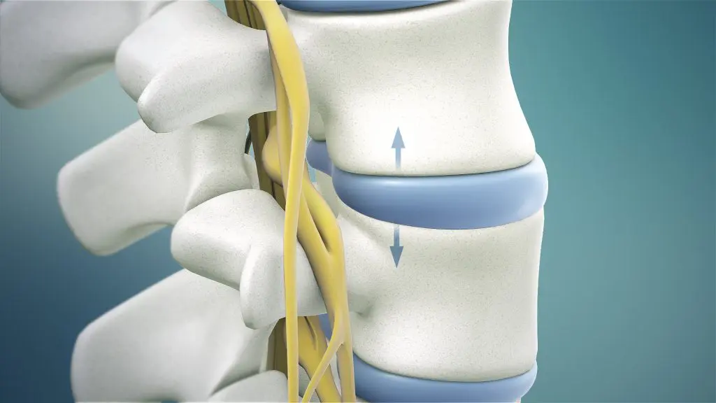Spinal Decompression Traction pulling vertebrae apart